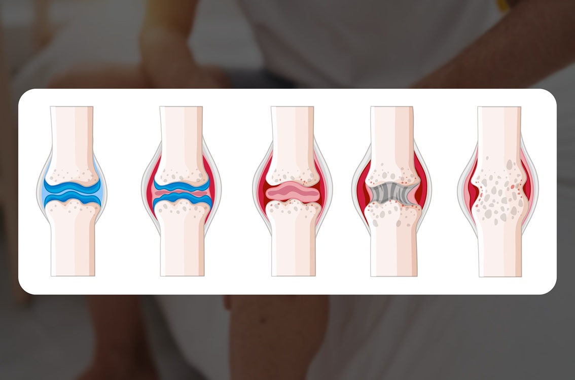 Knee Arthritis_Banner