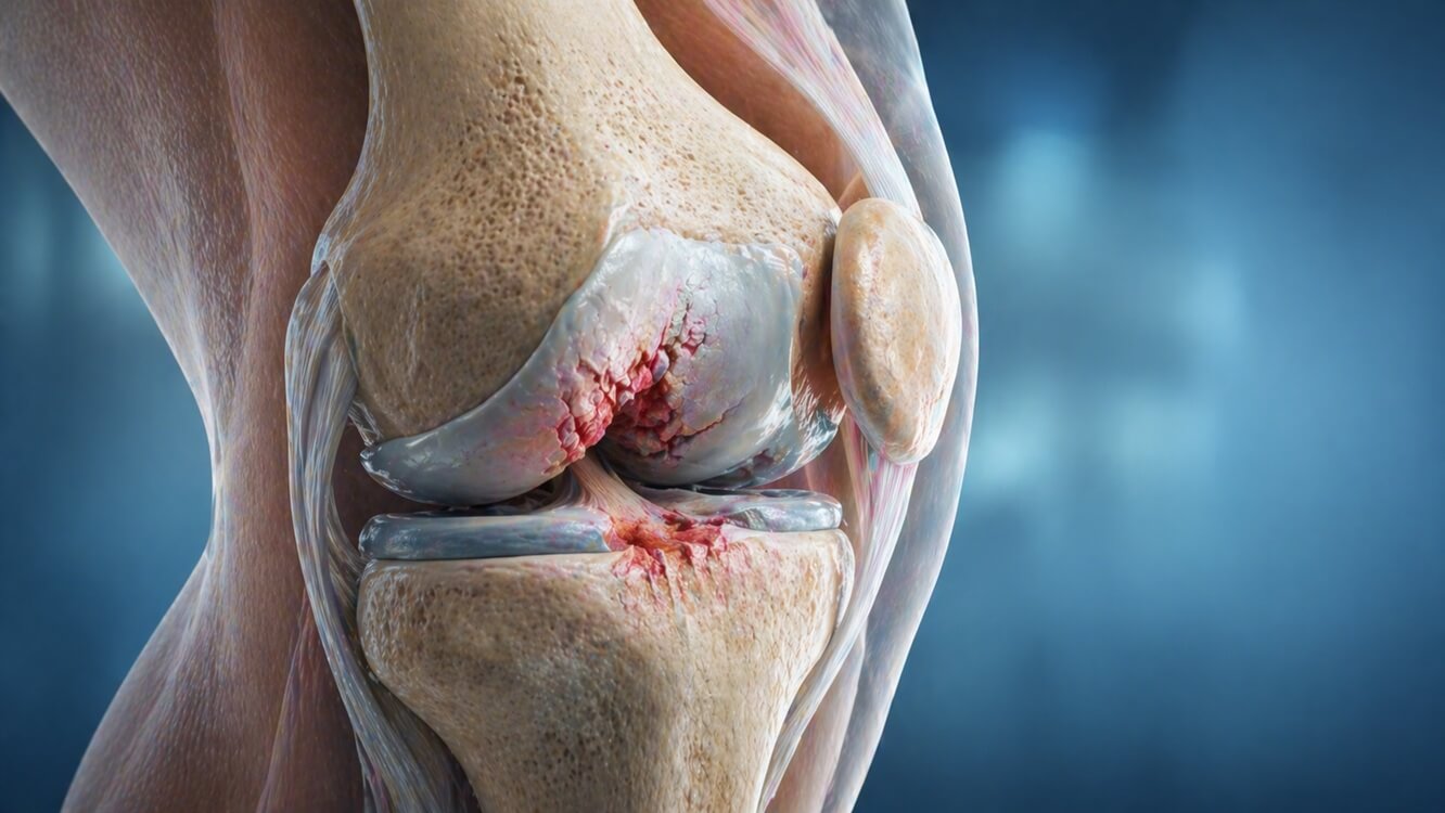 Knee Cartilage Defects_Banner