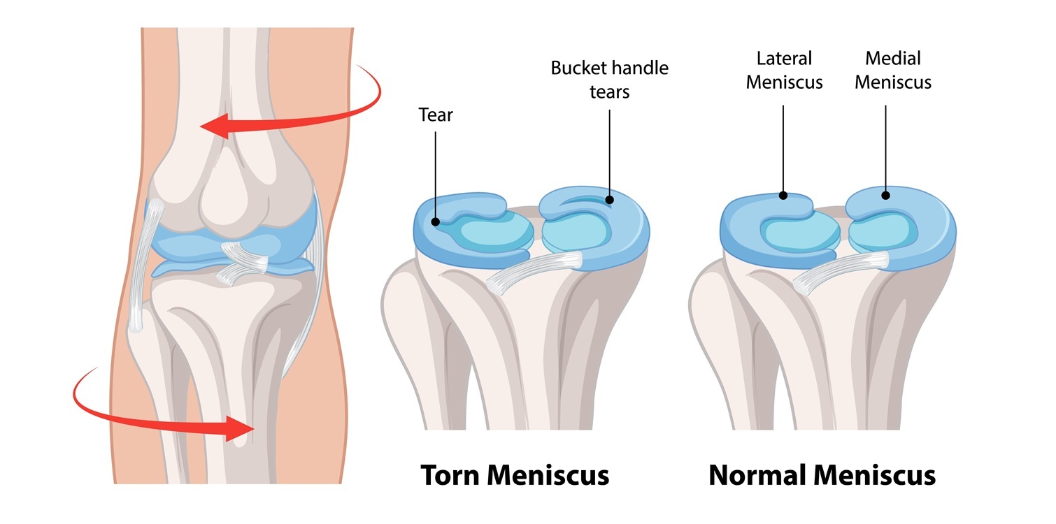 Meniscus Tears and Knee Injuries