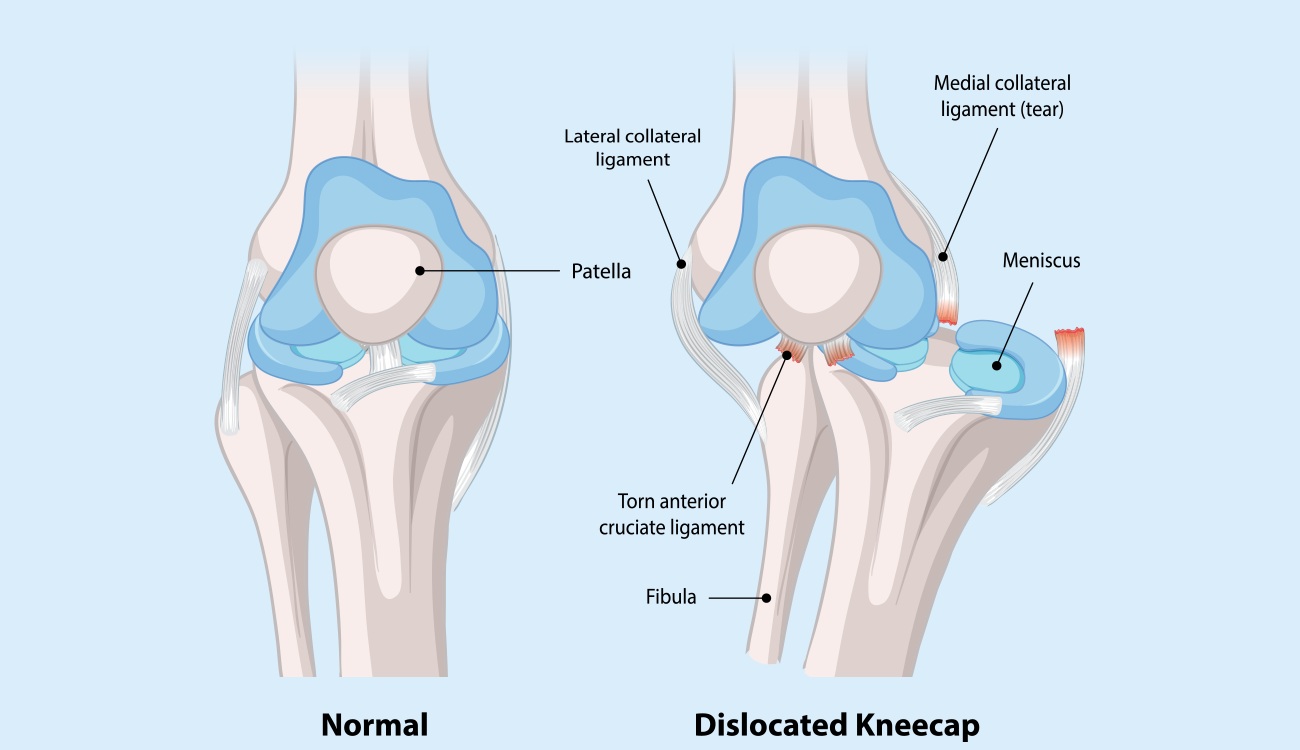Patellar Dislocation_Banner
