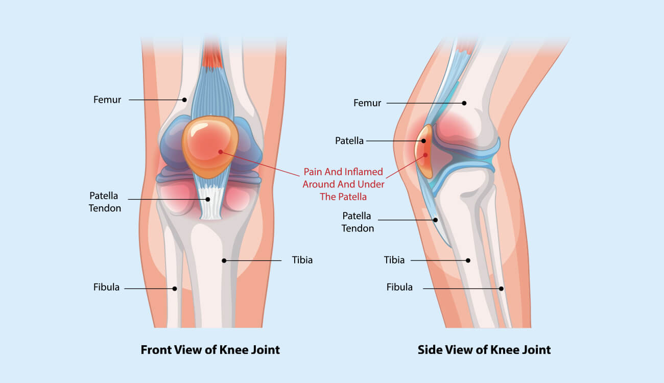 Patellfemoral pain syndrome & chondromalaia patellae_banner