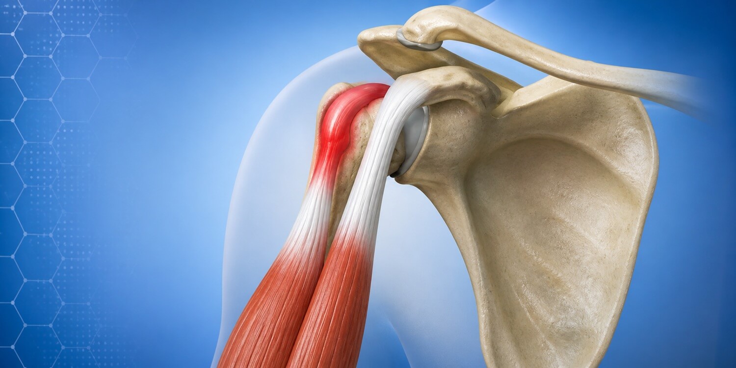 Biceps Tendinitis_Banner
