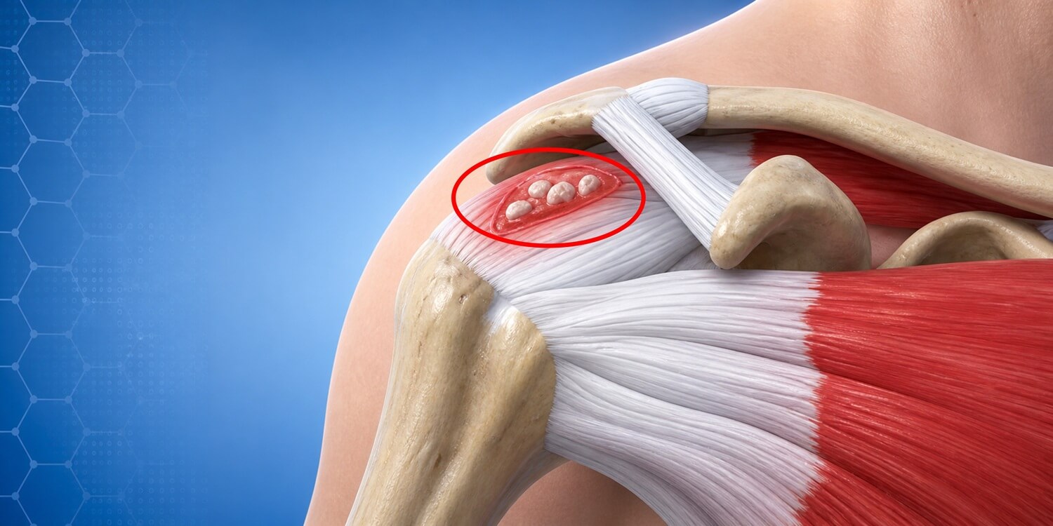 Calcific Tendinitis_Banner